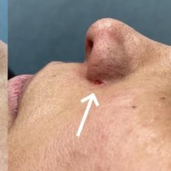 Mole Removal Before & After Patient #4121
