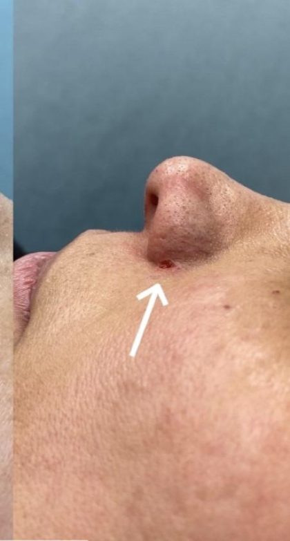 Mole Removal Before & After Patient #4121