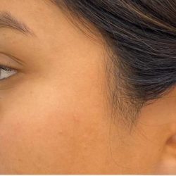 Nose Filler Before & After Patient #4132