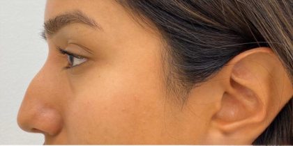 Nose Filler Before & After Patient #4132