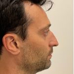 Nose Filler Before & After Patient #4142