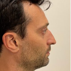 Nose Filler Before & After Patient #4142