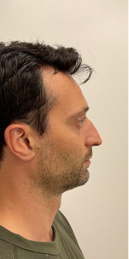 Nose Filler Before & After Patient #4142