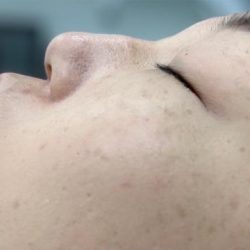 Nose Filler Before & After Patient #4122