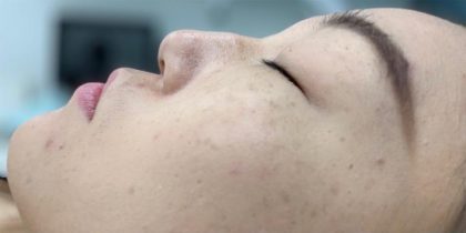Nose Filler Before & After Patient #4122