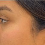 Nose Filler Before & After Patient #4132