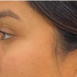 Nose Filler Before & After Patient #4132