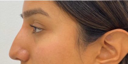 Nose Filler Before & After Patient #4132