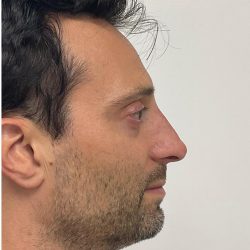 Nose Filler Before & After Patient #4142