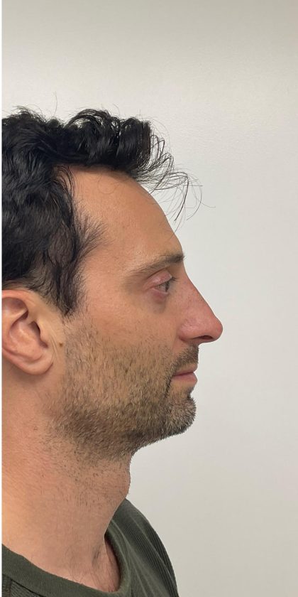 Nose Filler Before & After Patient #4142