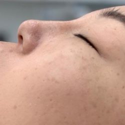 Nose Filler Before & After Patient #4122