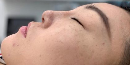 Nose Filler Before & After Patient #4122