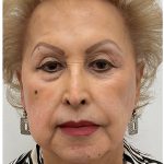 Nouvaderm Before & After Patient #4160