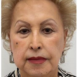 Nouvaderm Before & After Patient #4160