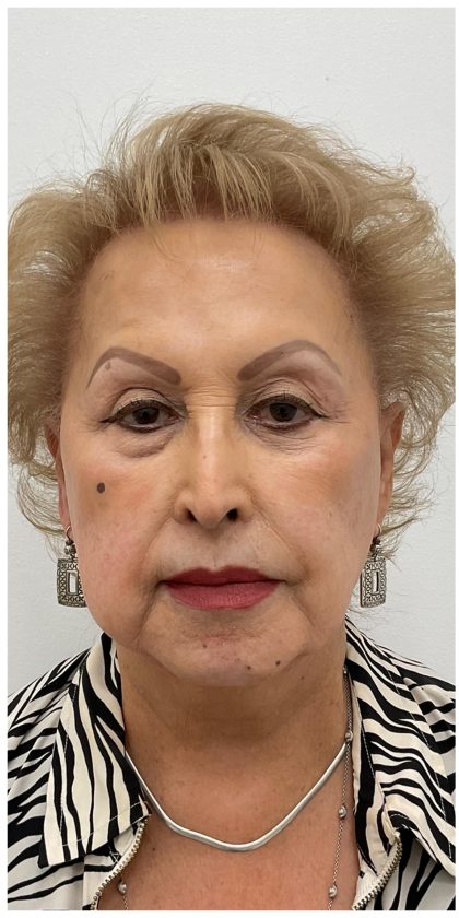 Nouvaderm Before & After Patient #4160