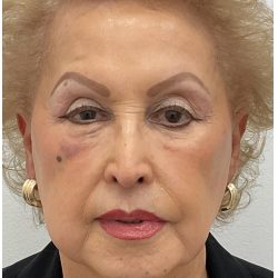 Nouvaderm Before & After Patient #4160