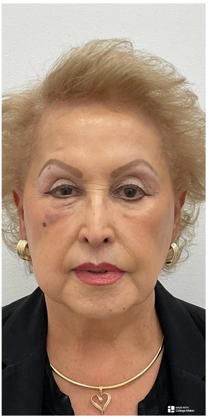 Nouvaderm Before & After Patient #4160