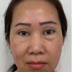 Under Eye Fillers Before & After Patient #4159