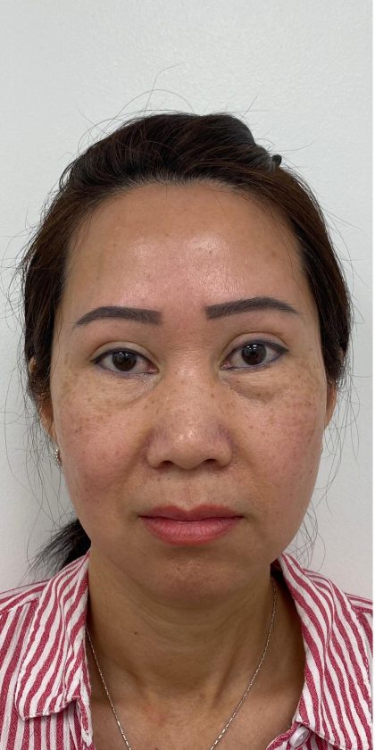 Under Eye Fillers Before & After Patient #4159