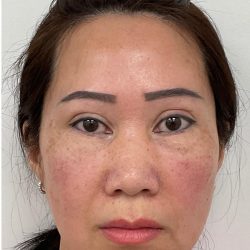 Under Eye Fillers Before & After Patient #4159