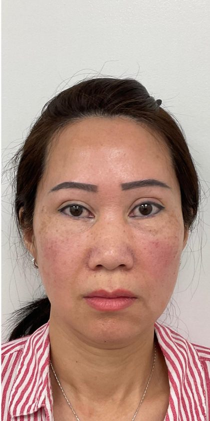 Under Eye Fillers Before & After Patient #4159