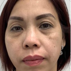 Under Eye Fillers Before & After Patient #4139