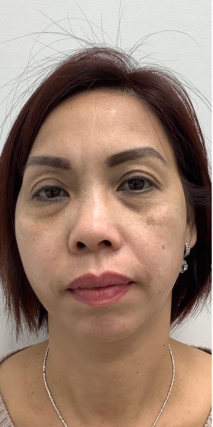 Under Eye Fillers Before & After Patient #4139