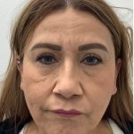 Under Eye Fillers Before & After Patient #4143