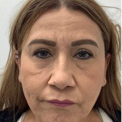 Under Eye Fillers Before & After Patient #4143
