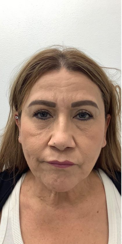 Under Eye Fillers Before & After Patient #4143