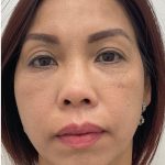 Under Eye Fillers Before & After Patient #4139