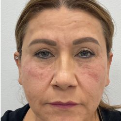Under Eye Fillers Before & After Patient #4143