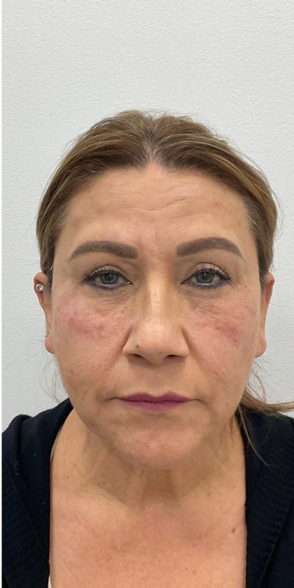 Under Eye Fillers Before & After Patient #4143