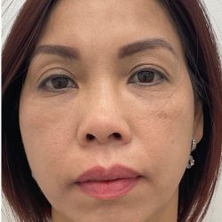 Under Eye Fillers Before & After Patient #4139