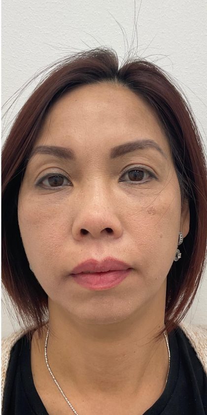 Under Eye Fillers Before & After Patient #4139