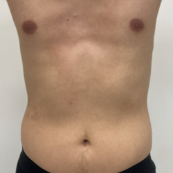 CoolSculpting Before & After Patient #4190