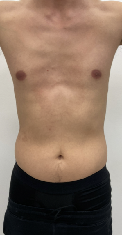 CoolSculpting Before & After Patient #4190
