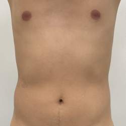CoolSculpting Before & After Patient #4190