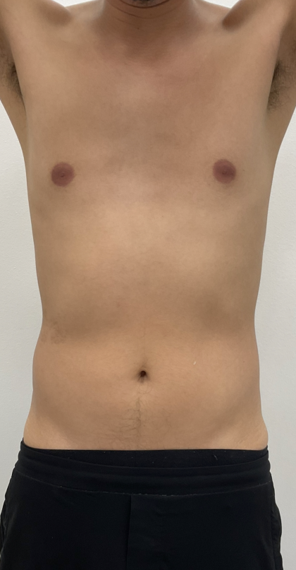 CoolSculpting Before & After Patient #4190