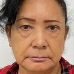 Lower Blepharoplasty Before & After Patient #4199