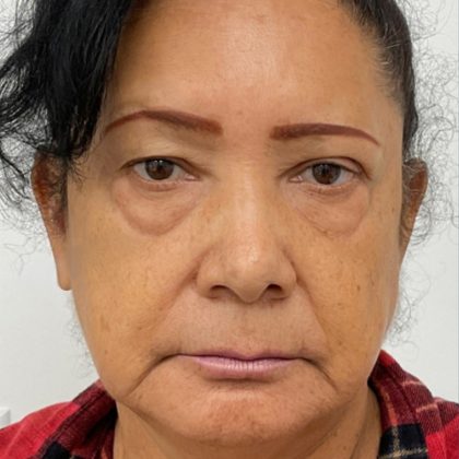 Lower Blepharoplasty Before & After Patient #4199
