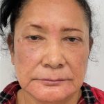 Lower Blepharoplasty Before & After Patient #4199