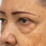 Lower Blepharoplasty Before & After Patient #4199