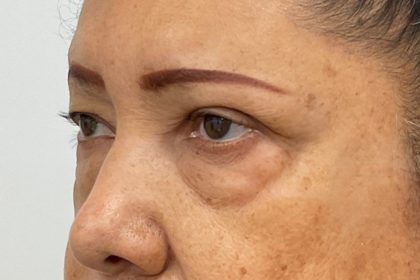 Lower Blepharoplasty Before & After Patient #4199