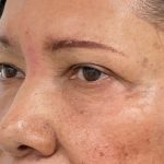 Lower Blepharoplasty Before & After Patient #4199