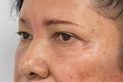Lower Blepharoplasty Before & After Patient #4199