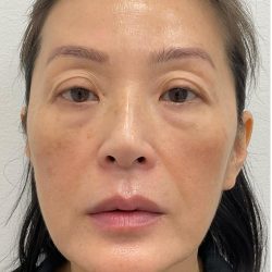 Facial Fillers Before & After Patient #4193