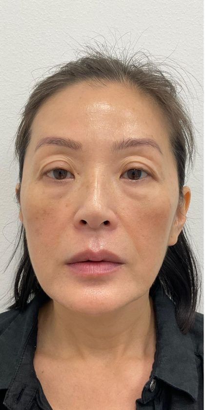 Facial Fillers Before & After Patient #4193