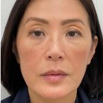Facial Fillers Before & After Patient #4193
