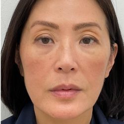 Facial Fillers Before & After Patient #4193